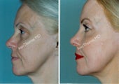 Non-Surgical Face Lift- Exoderm