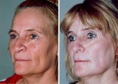Non-Surgical Face Lift- Exoderm