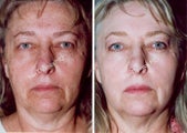 Non-Surgical Face Lift- Exoderm