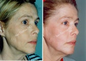 Non-Surgical Face Lift- Exoderm