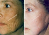 Non-Surgical Face Lift- Exoderm