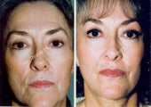 Non-Surgical Face Lift- Exoderm