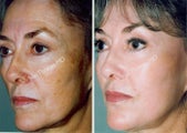 Non-Surgical Face Lift- Exoderm