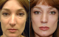 Liquid Face Lift with Silikon-1000