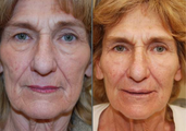 Non-surgical face lift with Silikon-1000