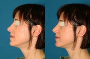 Non Surgical Rhinoplasty