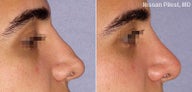 Nonsurgical Nose Reshaping - Radiesse