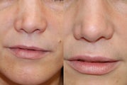 Non-Surgical Rhinoplasty and Lip Augmentation with Silikon-1000