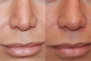 Non-Surgical Rhinoplasty using Silikon-1000