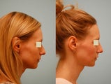 Injectable Fillers (Restylane/Perlane)