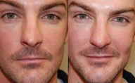 Non-Surgical Rhinoplasty with Silikon-1000