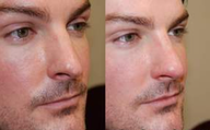 Non-Surgical Rhinoplasty with Silikon-1000