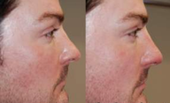 Non-Surgical Rhinoplasty with Silikon-1000