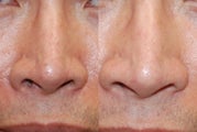Non-Surgical Rhinoplasty Lowering Nostril Height