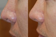 Non-Surgical Rhinoplasty Lowering Nostril Height