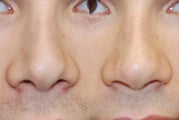 Non-Surgical Rhinoplasty using Silikon-1000