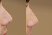 Non-Surgical Rhinoplasty using Silikon-1000