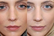 Non-Surgical Rhinoplasty to lower nostrils