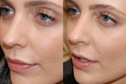 Non-Surgical Rhinoplasty