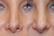 Non-Surgical Rhinoplasty with Silikon-1000