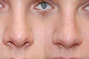 Non-Surgical Rhinoplasty. Front view.