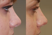 Non-Surgical Rhinoplasty. Profile view.