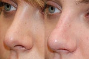 Non-Surgical Rhinoplasty. 3/4 view.