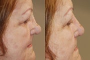 Non-Surgical Rhinoplasty using Silikon-1000