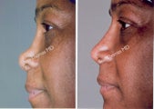 Non-Surgical Rhinoplasty