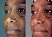 Non Surgical Rhinoplasty