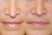 Non-Surgical Rhinoplasty with Silikon-1000