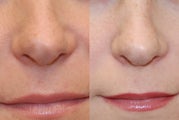 Non-Surgical Rhinoplasty using Silikon-1000