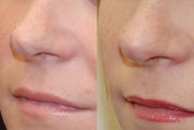 Non-Surgical Rhinoplasty with Silikon-1000