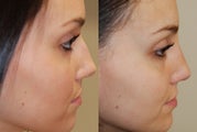 Non-Surgical Rhinoplasty with Silikon-1000