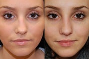 Non-Surgical Rhinoplasty with Silikon-1000