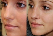Non-Surgical Rhinoplasty with Silikon-1000