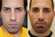 Non-Surgical Rhinoplasty with Silikon-1000
