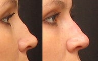 Non Surgical Nose Job