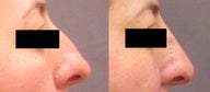 Non Surgical Nose Job