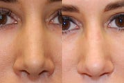 Non-Surgical Rhinoplasty with Silikon-1000