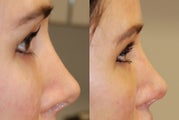 Non-Surgical Rhinoplasty with Silikon-1000