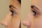 Non-Surgical Rhinoplasty with Silikon-1000 for a profile-bump