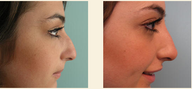 Non-Surgical Nose Job