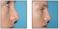Non-Surgical Nose Job