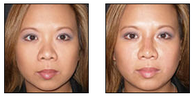 Non-Surgical Nose Job