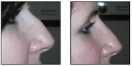 Non-Surgical Nose Job