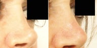 Non surgical rhinoplasty