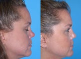 Non-surgical rhinoplasty