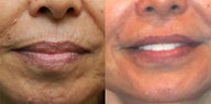 Non-surgical enhancement of the area around the mouth (perioral)