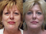 Non-surgical face lift